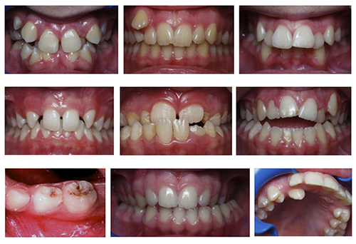 Photo of Dental Deformities