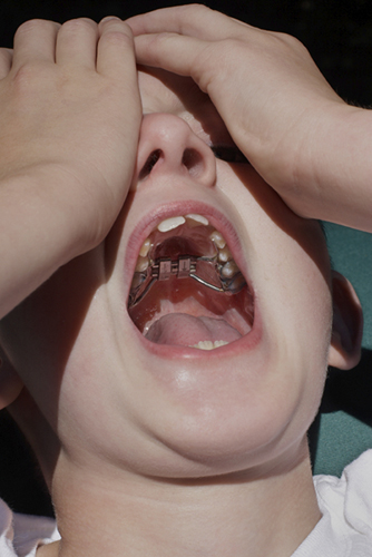 A photo of a boy with an open mouth showing his palatal expander.